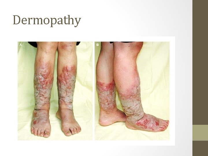 Dermopathy 