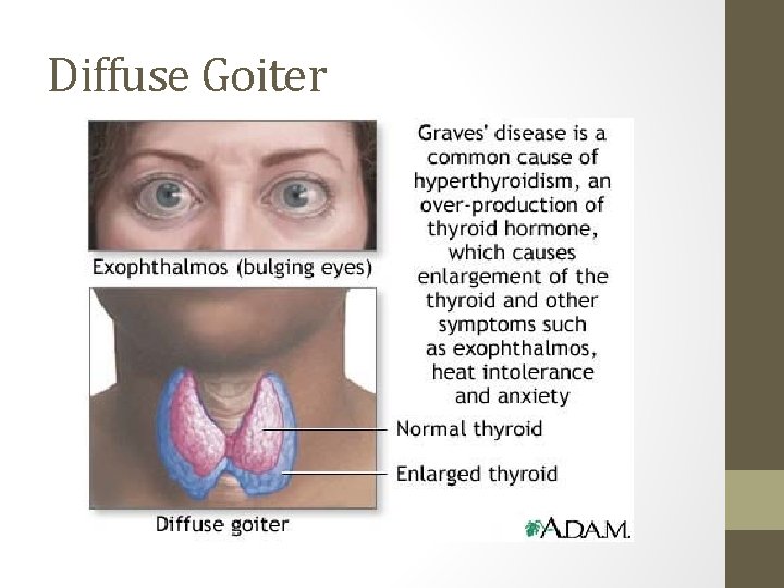 Diffuse Goiter 