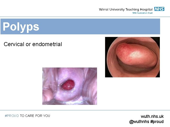 Polyps Cervical or endometrial #PROUD TO CARE FOR YOU wuth. nhs. uk @wuthnhs #proud