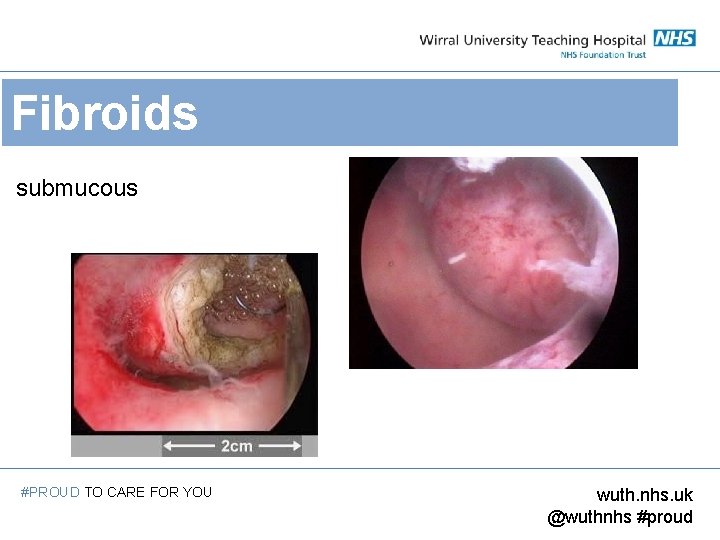 Fibroids submucous #PROUD TO CARE FOR YOU wuth. nhs. uk @wuthnhs #proud 