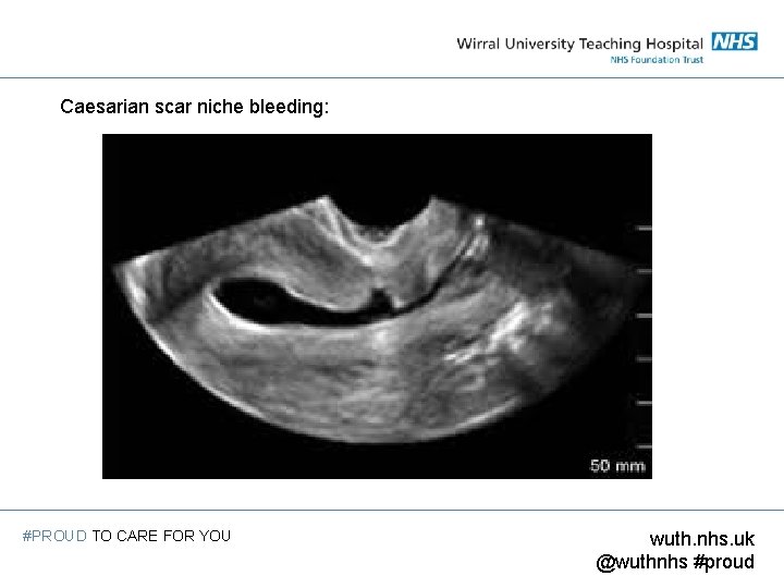 Caesarian scar niche bleeding: #PROUD TO CARE FOR YOU wuth. nhs. uk @wuthnhs #proud