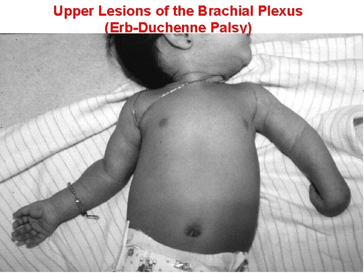 Upper Lesions of the Brachial Plexus (Erb-Duchenne Palsy) Waiter’s tip position Upper limb hanging