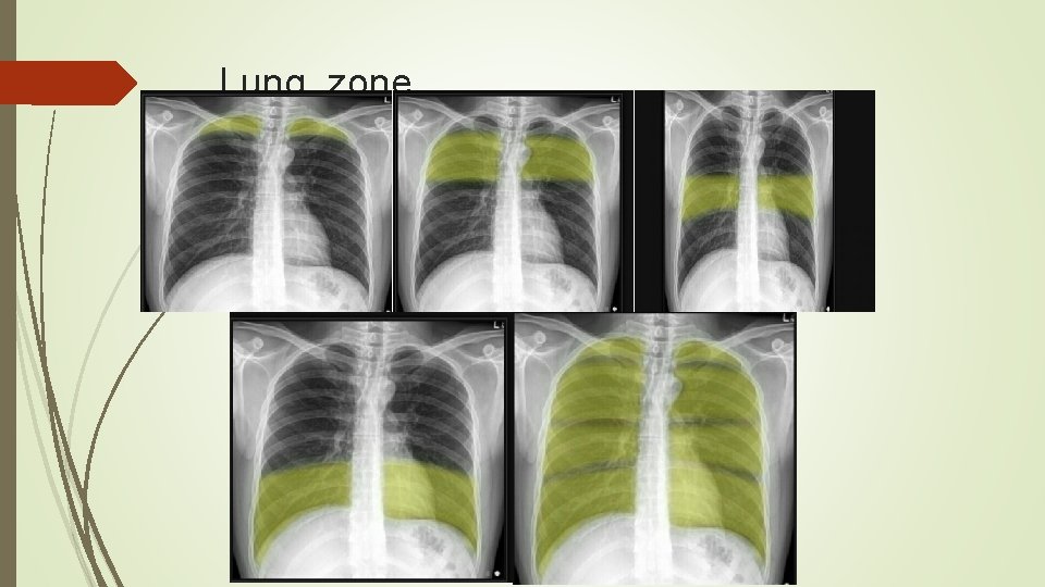 Lung zone 