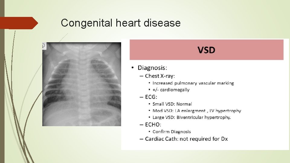 Congenital heart disease 