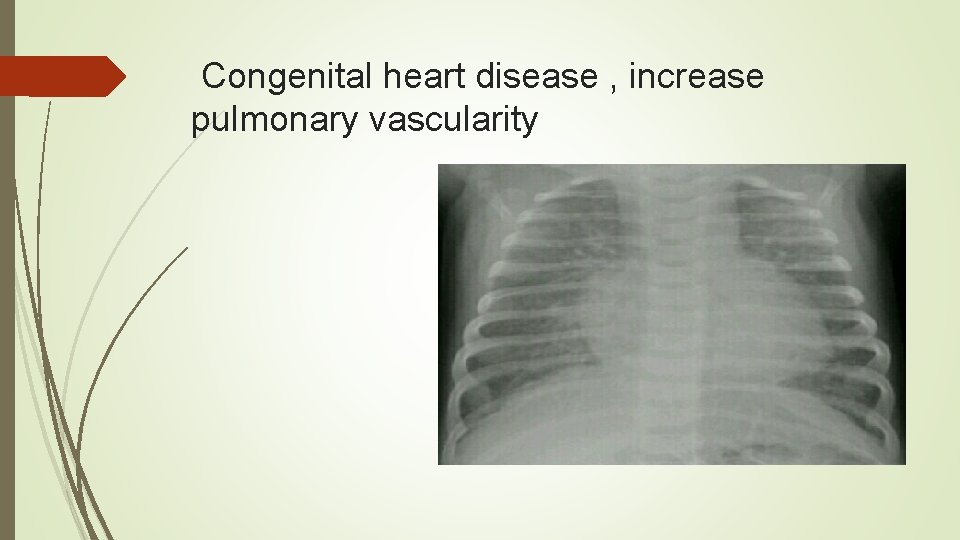Congenital heart disease , increase pulmonary vascularity 