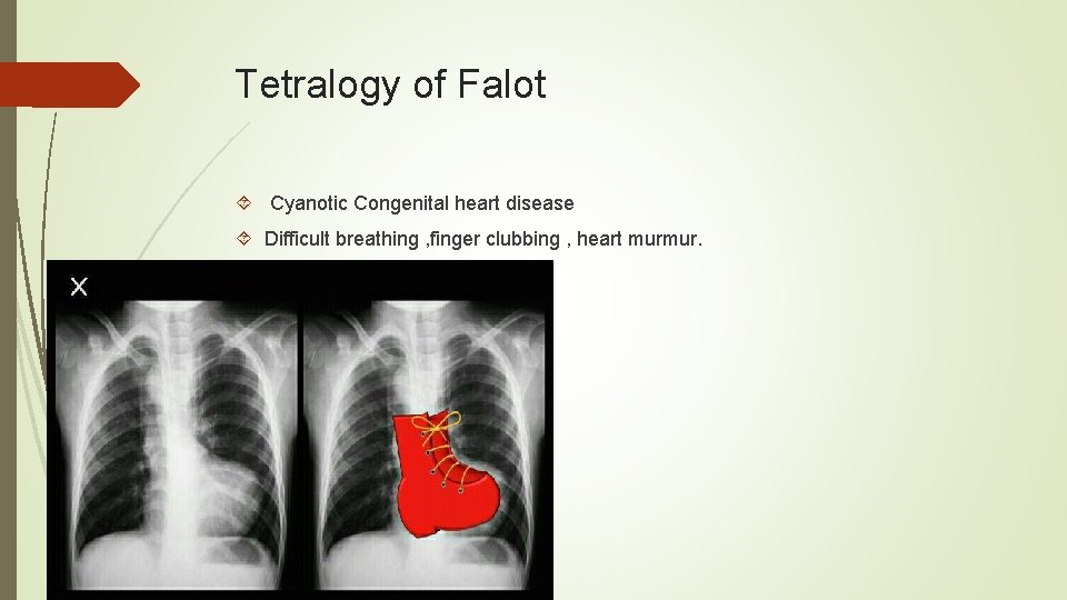 Tetralogy of Falot Cyanotic Congenital heart disease Difficult breathing , finger clubbing , heart