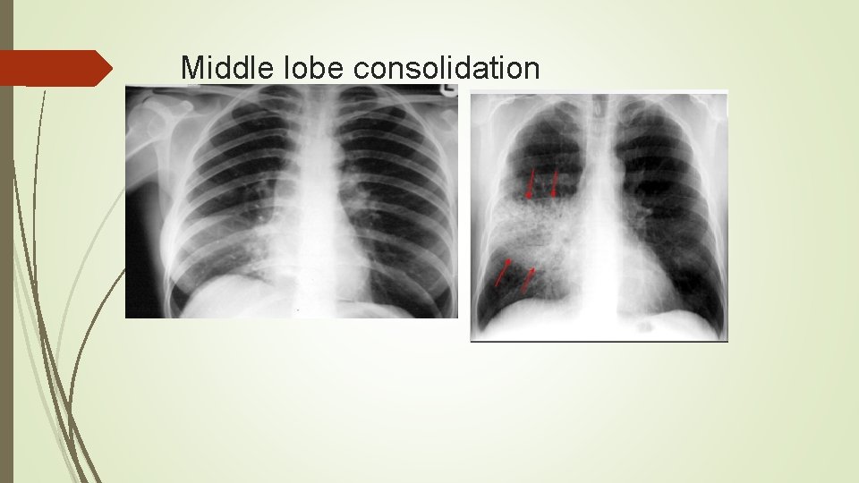 Middle lobe consolidation 