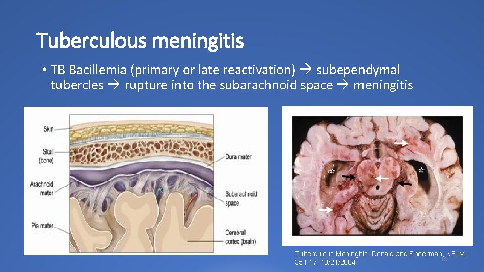 Tuberculous meningitis • TB Bacillemia (primary or late reactivation) subependymal tubercles rupture into the