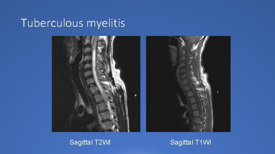 Tuberculous myelitis Sagittal T 2 WI Sagittal T 1 WI 