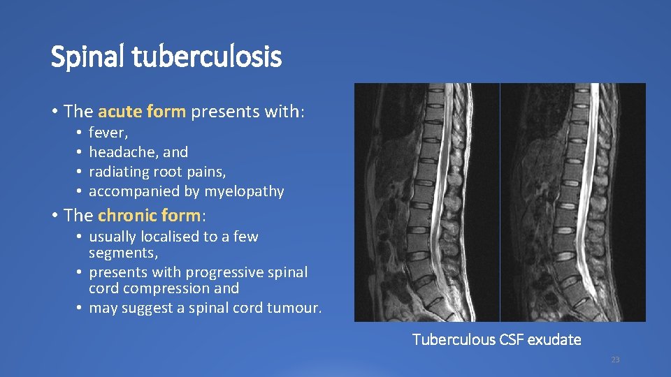 Spinal tuberculosis • The acute form presents with: • • fever, headache, and radiating