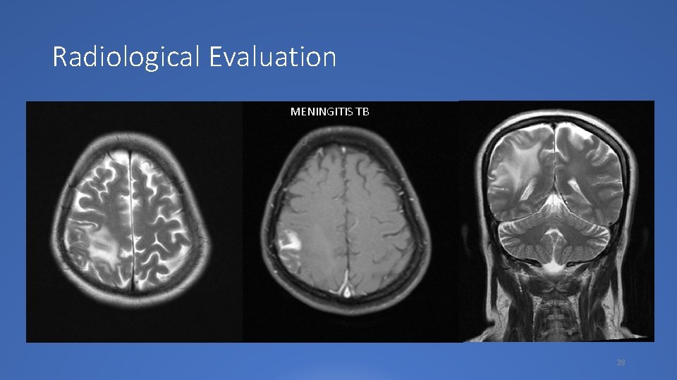 Radiological Evaluation MENINGITIS TB 28 