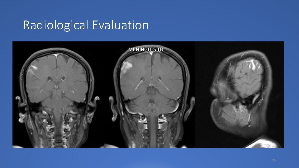 Radiological Evaluation MENINGITIS TB 29 