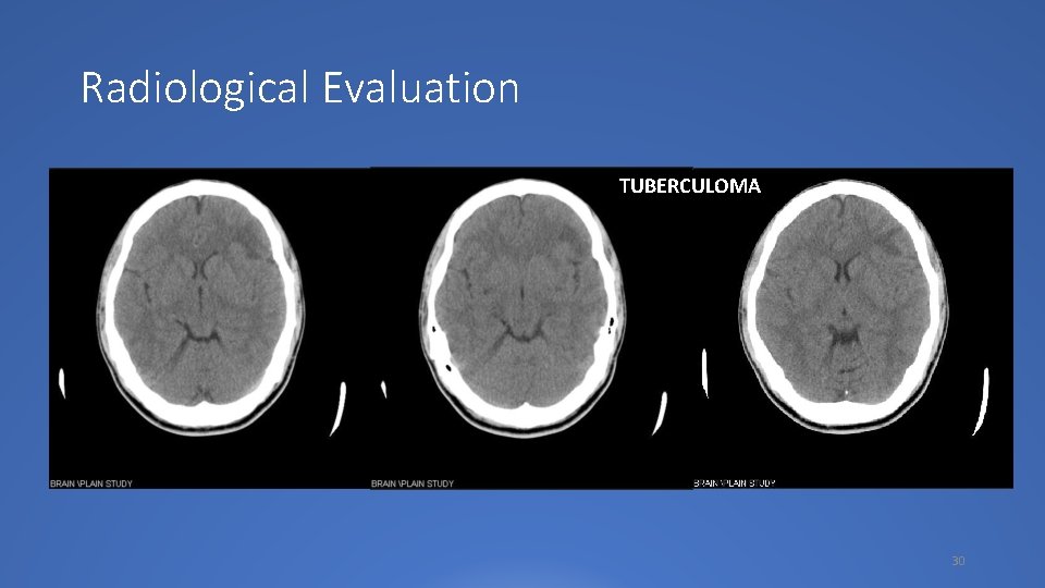 Radiological Evaluation TUBERCULOMA 30 