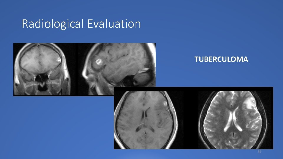 Radiological Evaluation TUBERCULOMA 31 