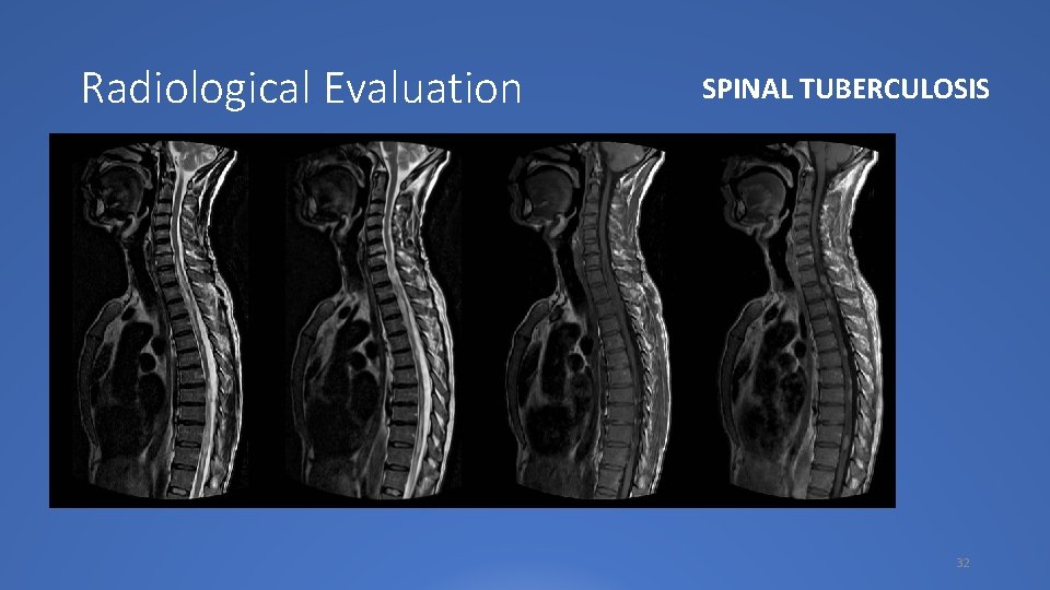 Radiological Evaluation SPINAL TUBERCULOSIS 32 