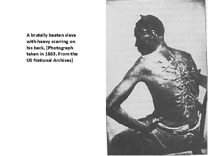 A brutally beaten slave with heavy scarring on his back, (Photograph taken in 1863.