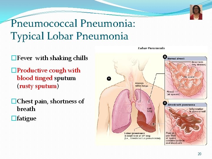 Pneumococcal Pneumonia: Typical Lobar Pneumonia �Fever with shaking chills �Productive cough with blood tinged