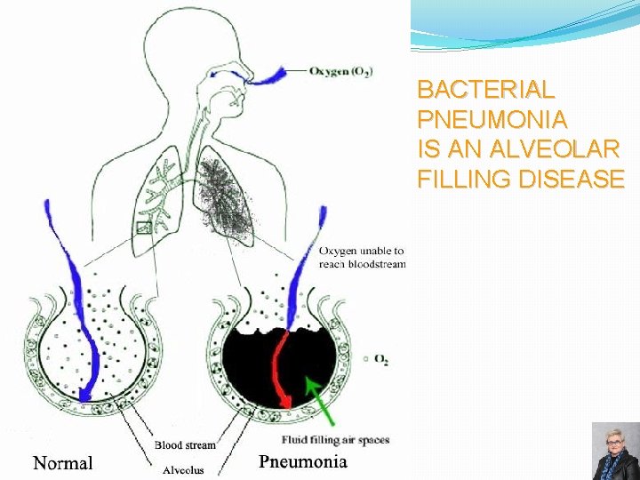 BACTERIAL PNEUMONIA IS AN ALVEOLAR FILLING DISEASE 55 