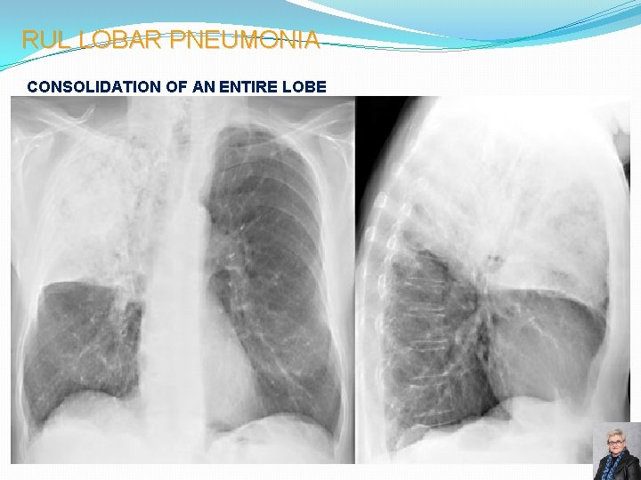 RUL LOBAR PNEUMONIA CONSOLIDATION OF AN ENTIRE LOBE 58 