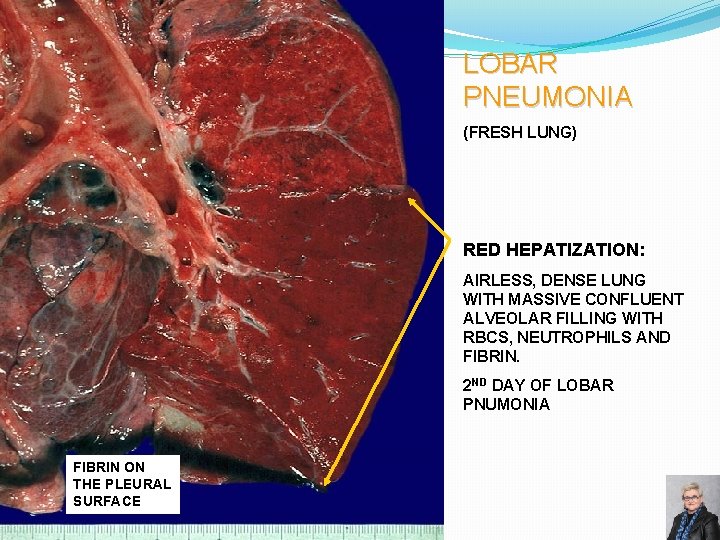LOBAR PNEUMONIA (FRESH LUNG) RED HEPATIZATION: AIRLESS, DENSE LUNG WITH MASSIVE CONFLUENT ALVEOLAR FILLING