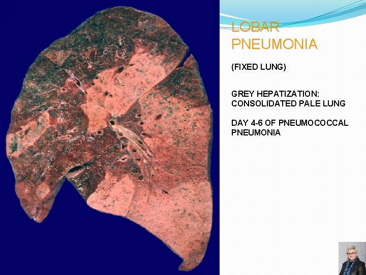 LOBAR PNEUMONIA (FIXED LUNG) GREY HEPATIZATION: CONSOLIDATED PALE LUNG DAY 4 -6 OF PNEUMOCOCCAL