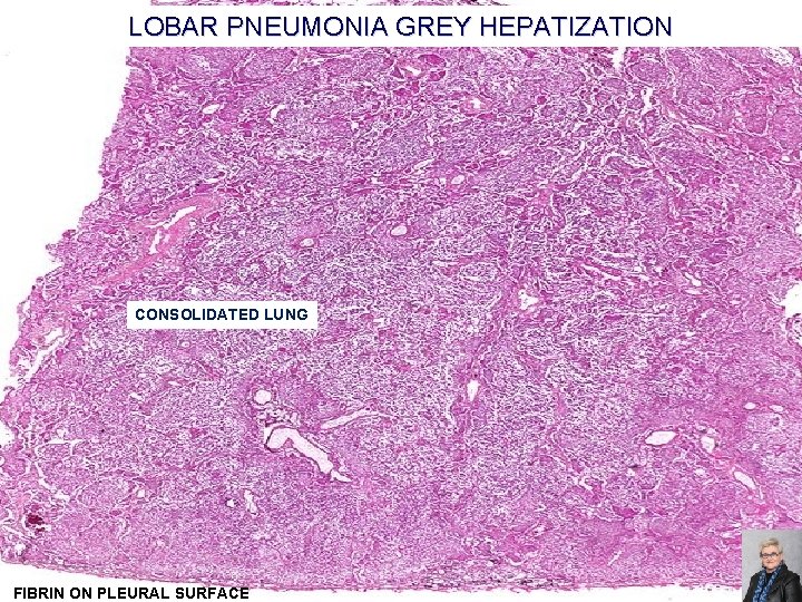 LOBAR PNEUMONIA GREY HEPATIZATION CONSOLIDATED LUNG FIBRIN ON PLEURAL SURFACE 63 