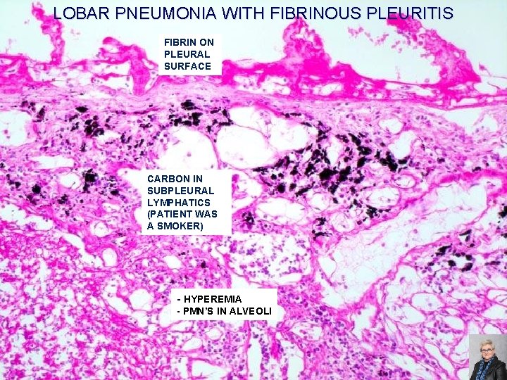 LOBAR PNEUMONIA WITH FIBRINOUS PLEURITIS FIBRIN ON PLEURAL SURFACE CARBON IN SUBPLEURAL LYMPHATICS (PATIENT