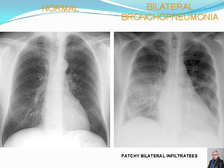 NORMAL BILATERAL BRONCHOPNEUMONIA PATCHY BILATERAL INFILTRATEES 68 