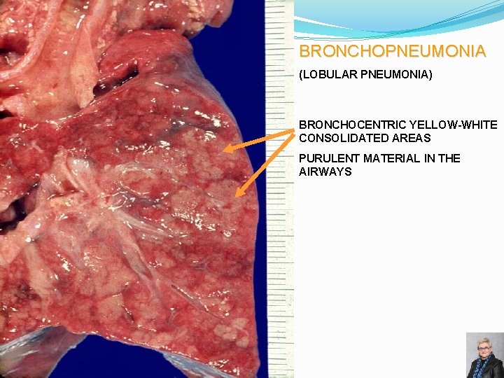 BRONCHOPNEUMONIA (LOBULAR PNEUMONIA) BRONCHOCENTRIC YELLOW-WHITE CONSOLIDATED AREAS PURULENT MATERIAL IN THE AIRWAYS 69 