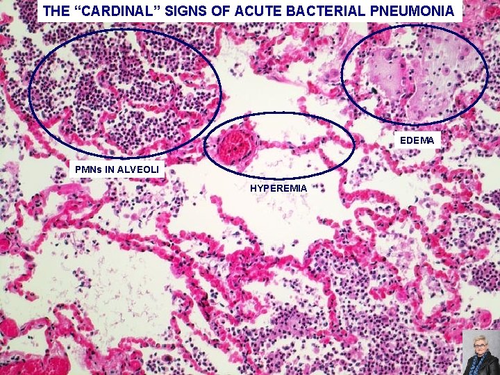 THE “CARDINAL” SIGNS OF ACUTE BACTERIAL PNEUMONIA EDEMA PMNs IN ALVEOLI HYPEREMIA 71 