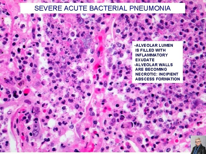 SEVERE ACUTE BACTERIAL PNEUMONIA -ALVEOLAR LUMEN IS FILLED WITH INFLAMMATORY EXUDATE -ALVEOLAR WALLS ARE