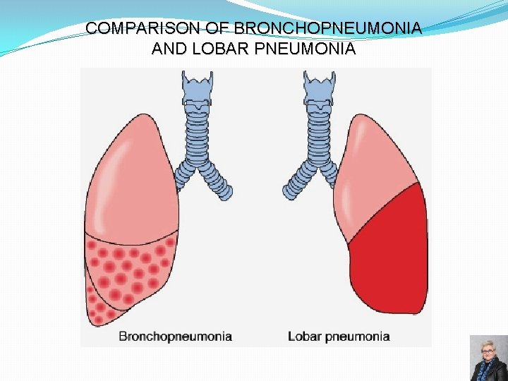 COMPARISON OF BRONCHOPNEUMONIA AND LOBAR PNEUMONIA 74 