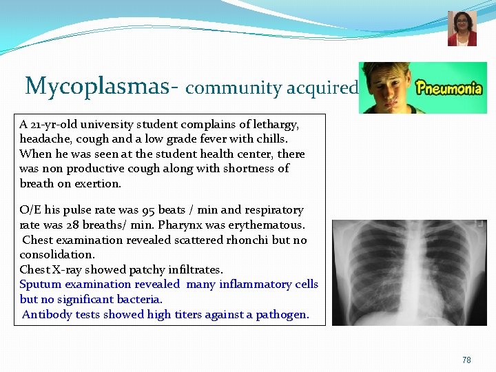 Mycoplasmas- community acquired A 21 -yr-old university student complains of lethargy, headache, cough and