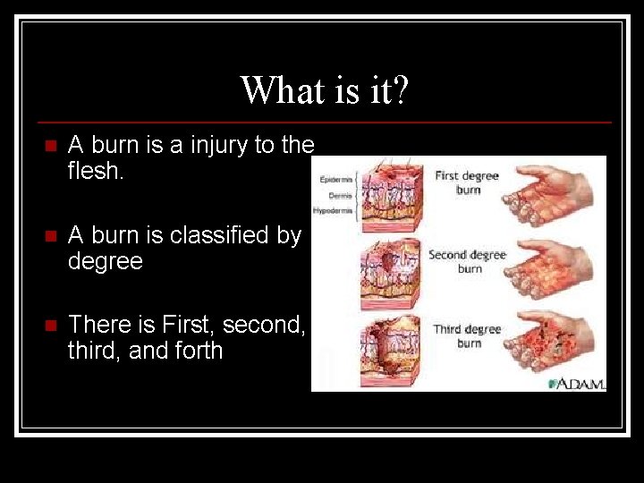 What is it? n A burn is a injury to the flesh. n A