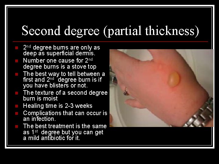 Second degree (partial thickness) n n n n 2 nd degree burns are only