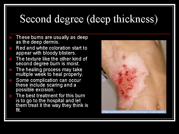Second degree (deep thickness) n n n These burns are usually as deep as