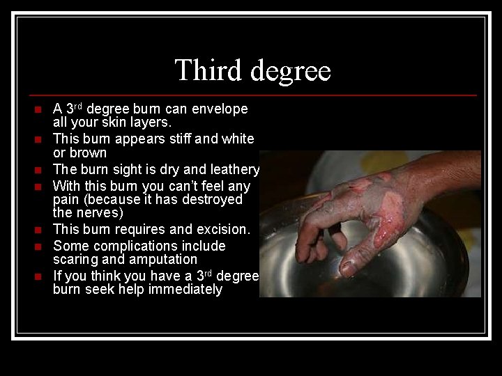 Third degree n n n n A 3 rd degree burn can envelope all