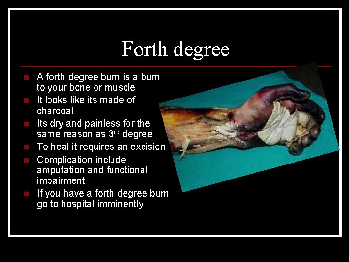 Forth degree n n n A forth degree burn is a burn to your