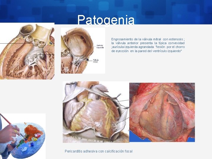 Patogenia Engrosamiento de la válvula mitral con estenosis ; la válvula anterior presenta la