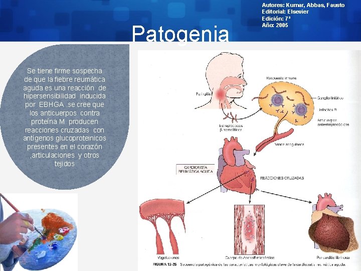 Patogenia Se tiene firme sospecha de que la fiebre reumática aguda es una reacción