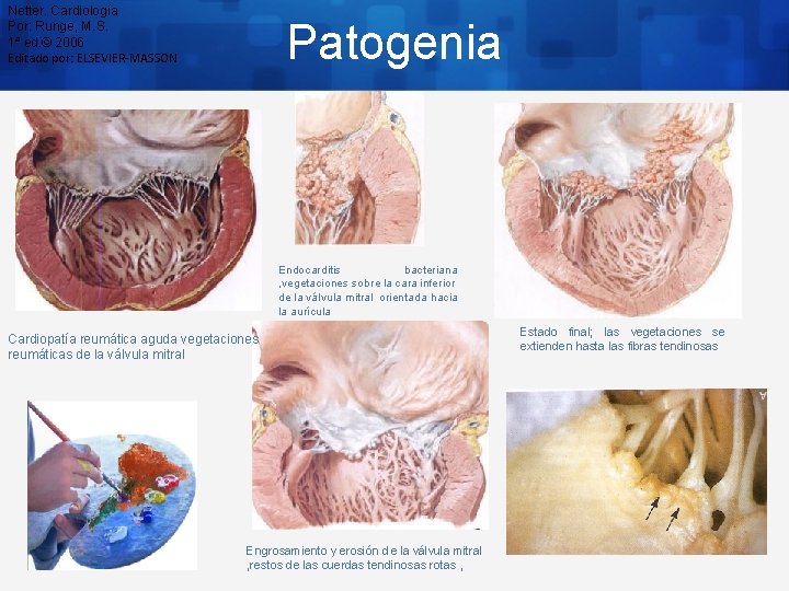 Netter. Cardiología Por: Runge, M. S. 1ª ed. © 2006 Editado por: ELSEVIER-MASSON Patogenia