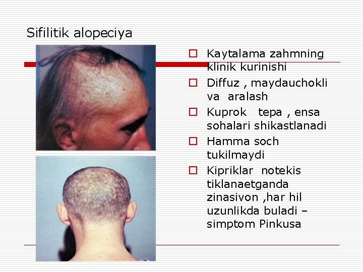 Sifilitik alopeciya o Kaytalama zahmning klinik kurinishi o Diffuz , maydauchokli va aralash o