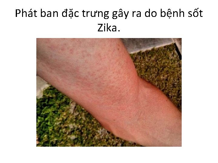 Phát ban đặc trưng gây ra do bệnh sốt Zika. 