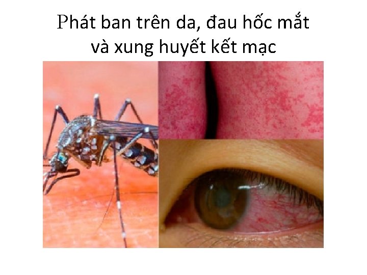 Phát ban trên da, đau hốc mắt và xung huyết kết mạc 