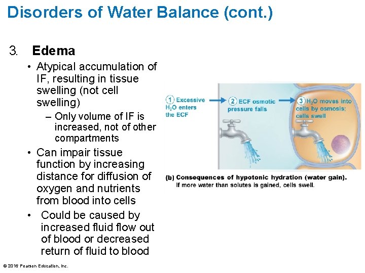 Disorders of Water Balance (cont. ) 3. Edema • Atypical accumulation of IF, resulting