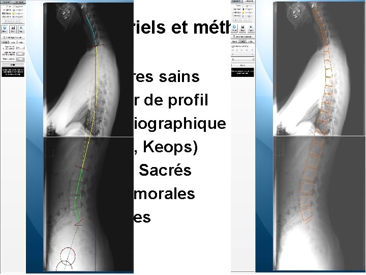 Matériels et méthodes • 296 volontaires sains • Rachis Entier de profil • Analyse