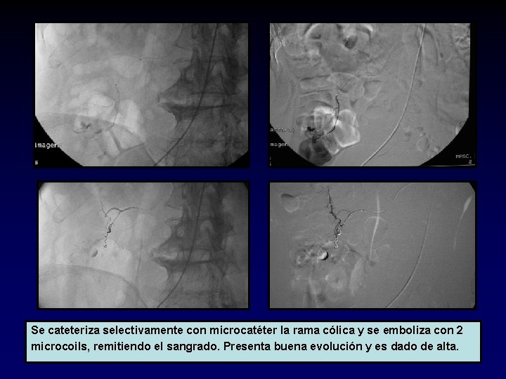 Se cateteriza selectivamente con microcatéter la rama cólica y se emboliza con 2 microcoils,