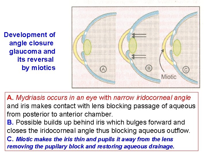 Development of angle closure glaucoma and its reversal by miotics A. Mydriasis occurs in