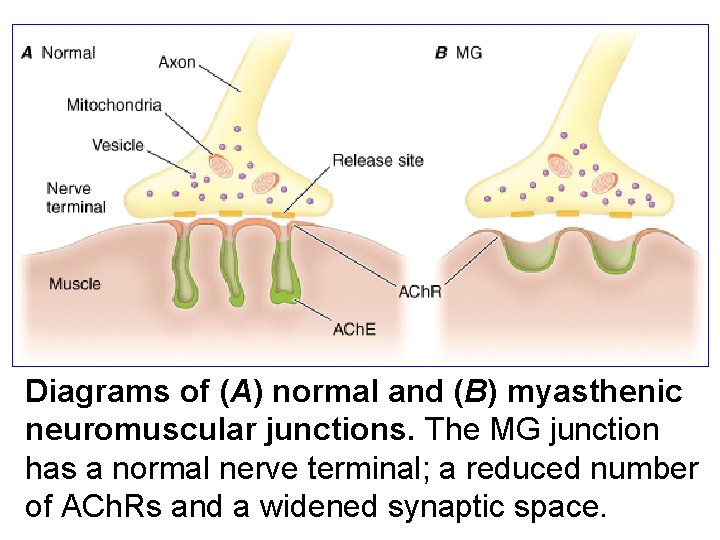 Diagrams of (A) normal and (B) myasthenic neuromuscular junctions. The MG junction has a