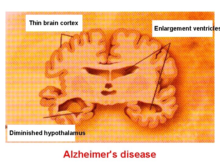 Thin brain cortex Enlargement ventricles Diminished hypothalamus Alzheimer's disease 